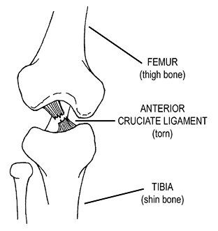 Broken Acl