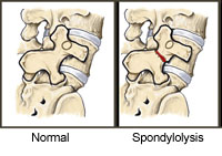 spondylolysis spondylolysis